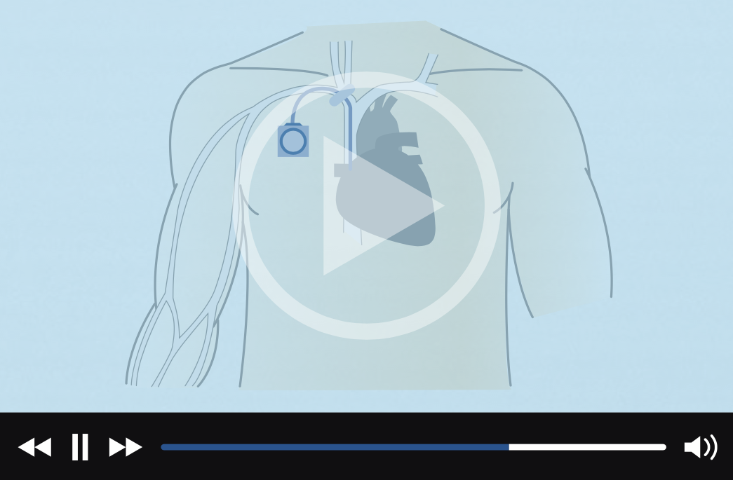 Video Thumbnail - PORT-A-CATH